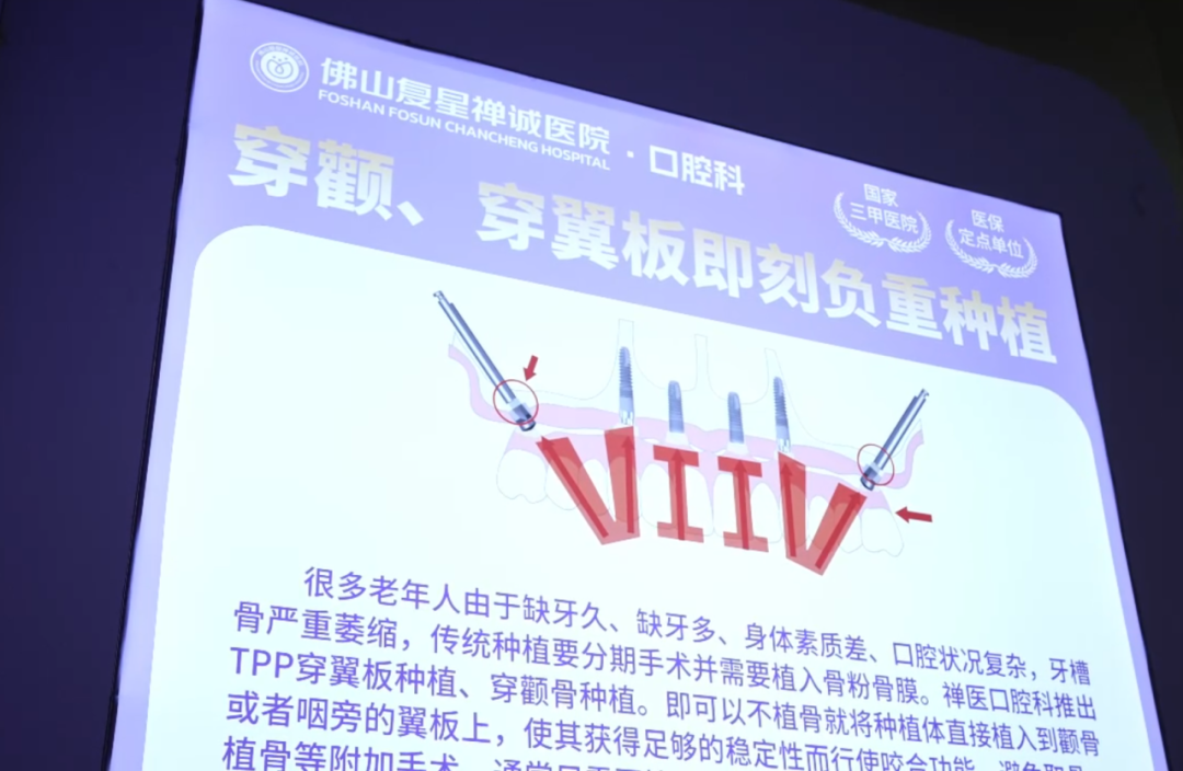 VIIV穿颧种植手术