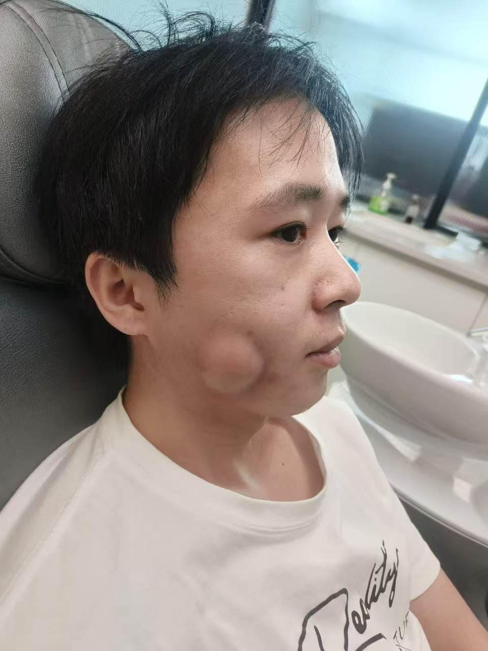 牙瘤案例