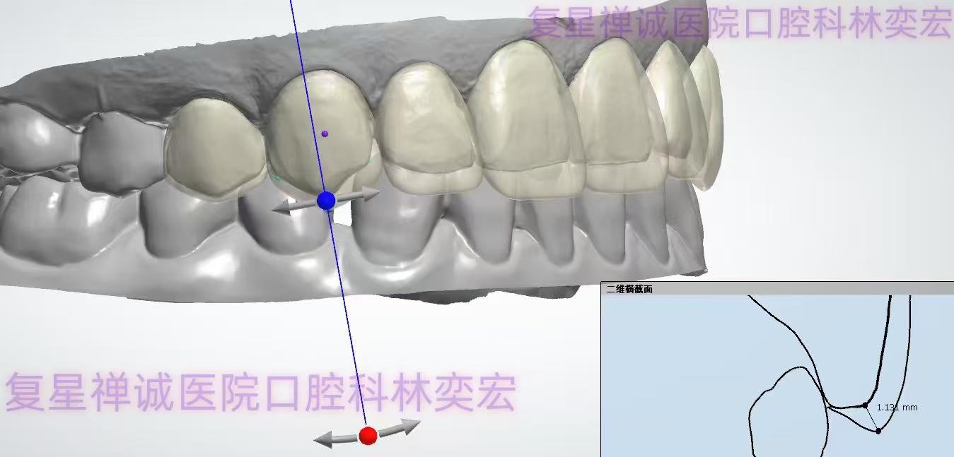 唇腭裂案例