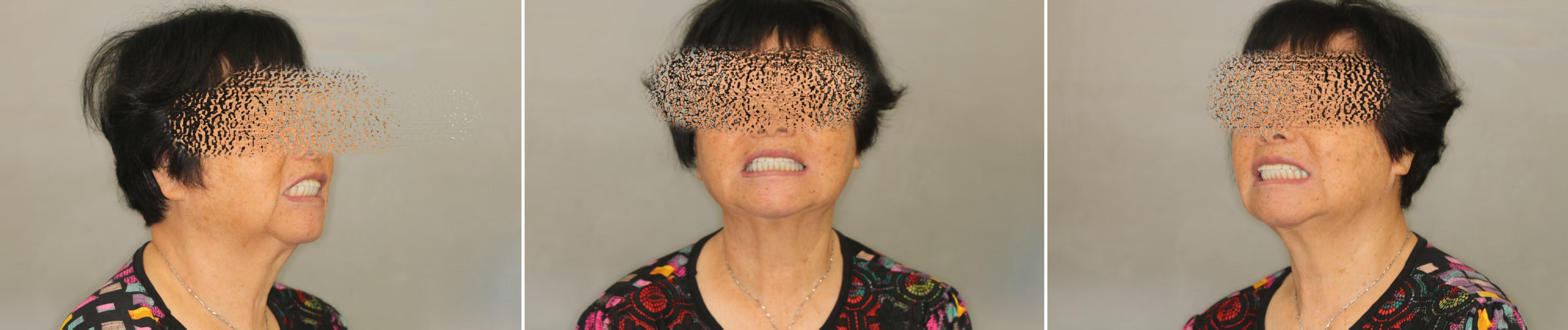 80岁患者