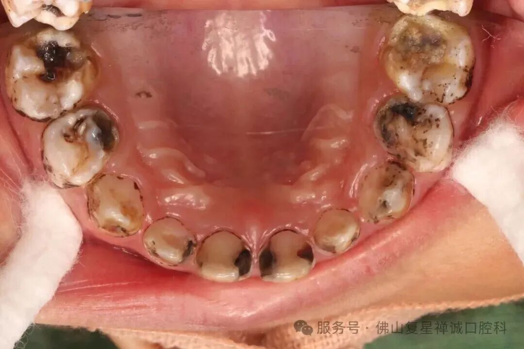 全麻治疗流程