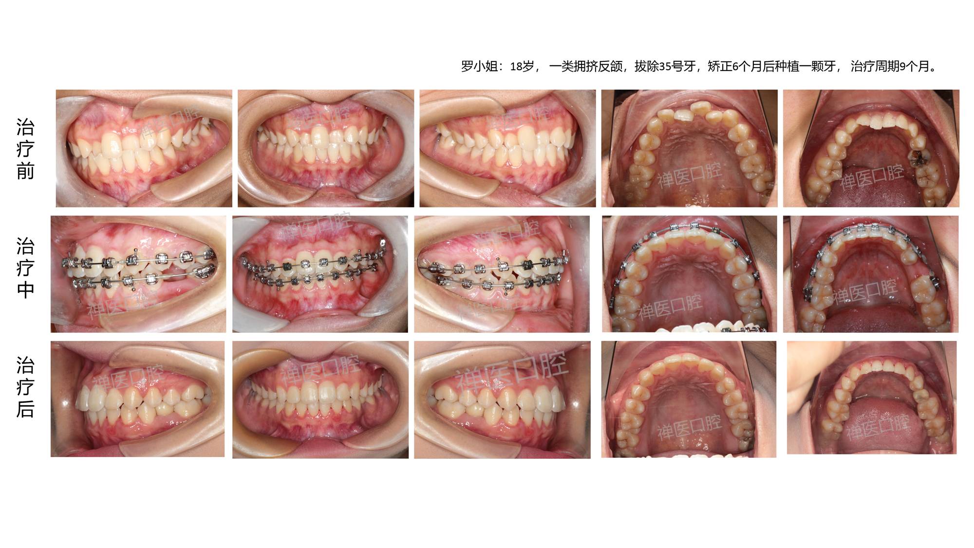 牵引后效果