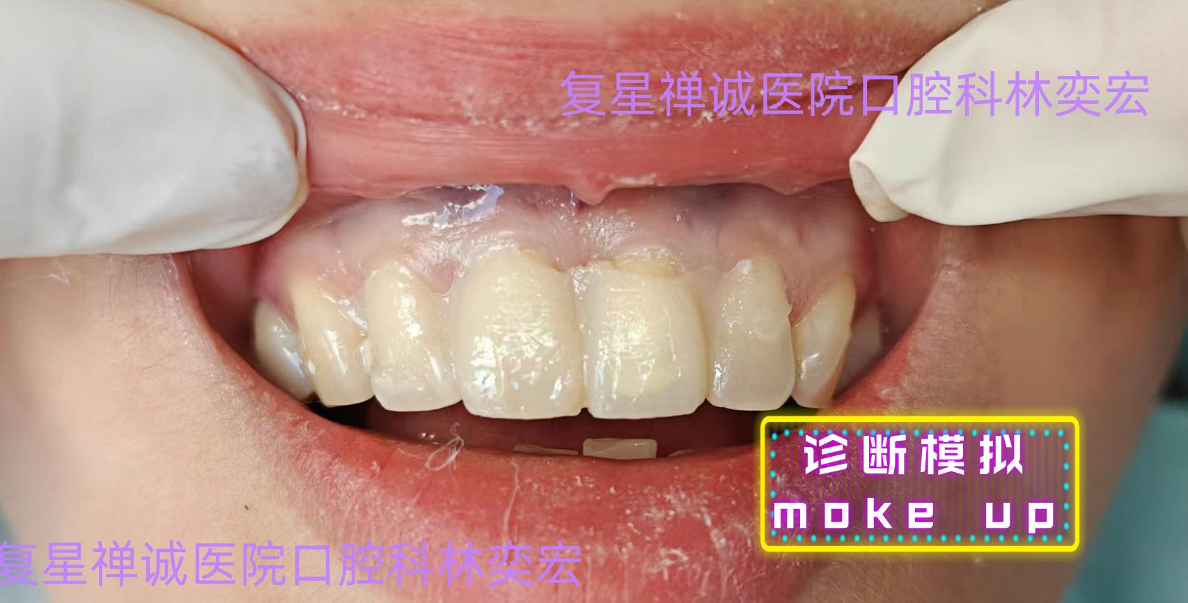 牙瘤案例