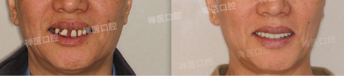 82岁穿颧穿翼案例