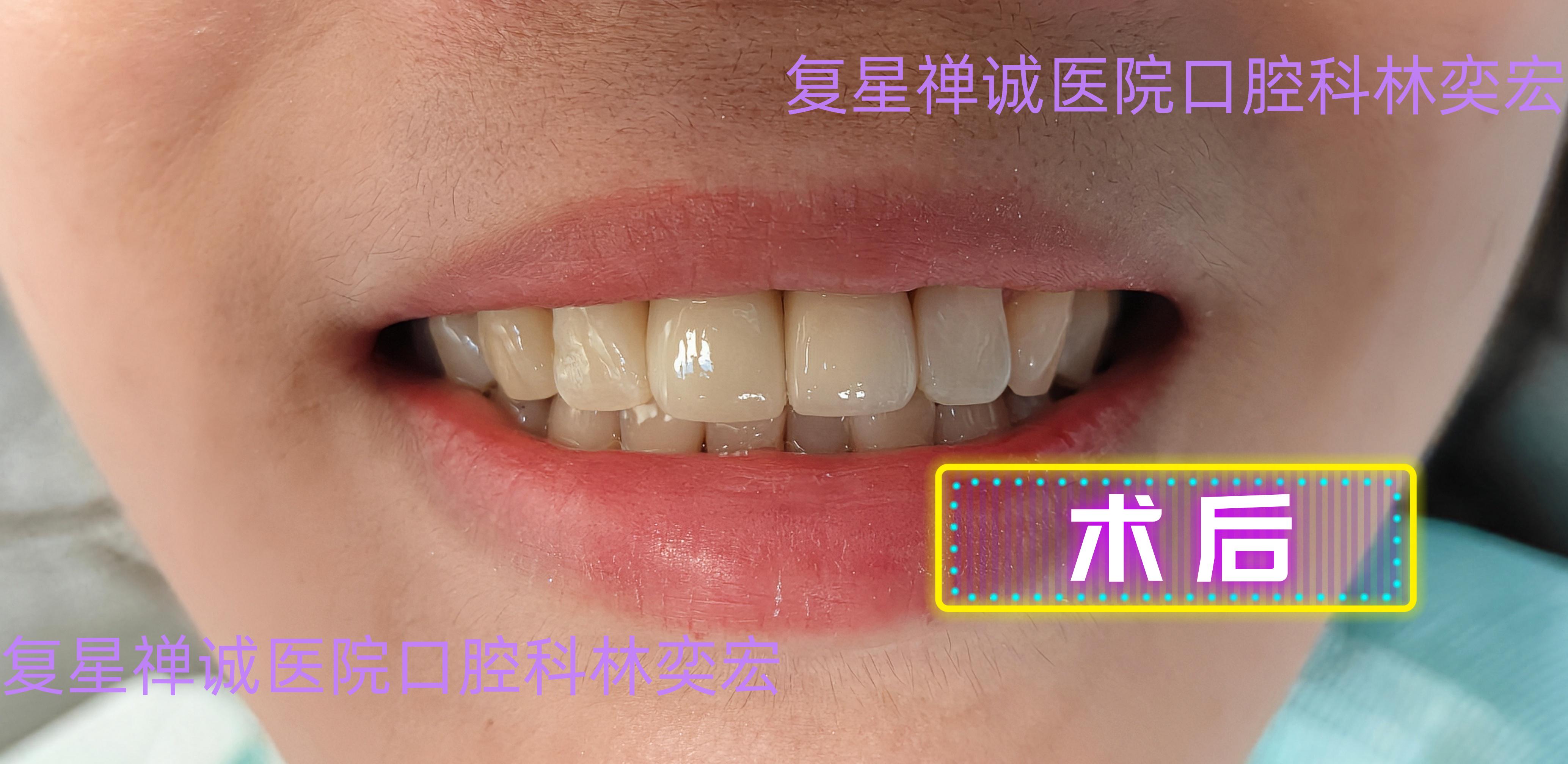 舌下导管结石术前