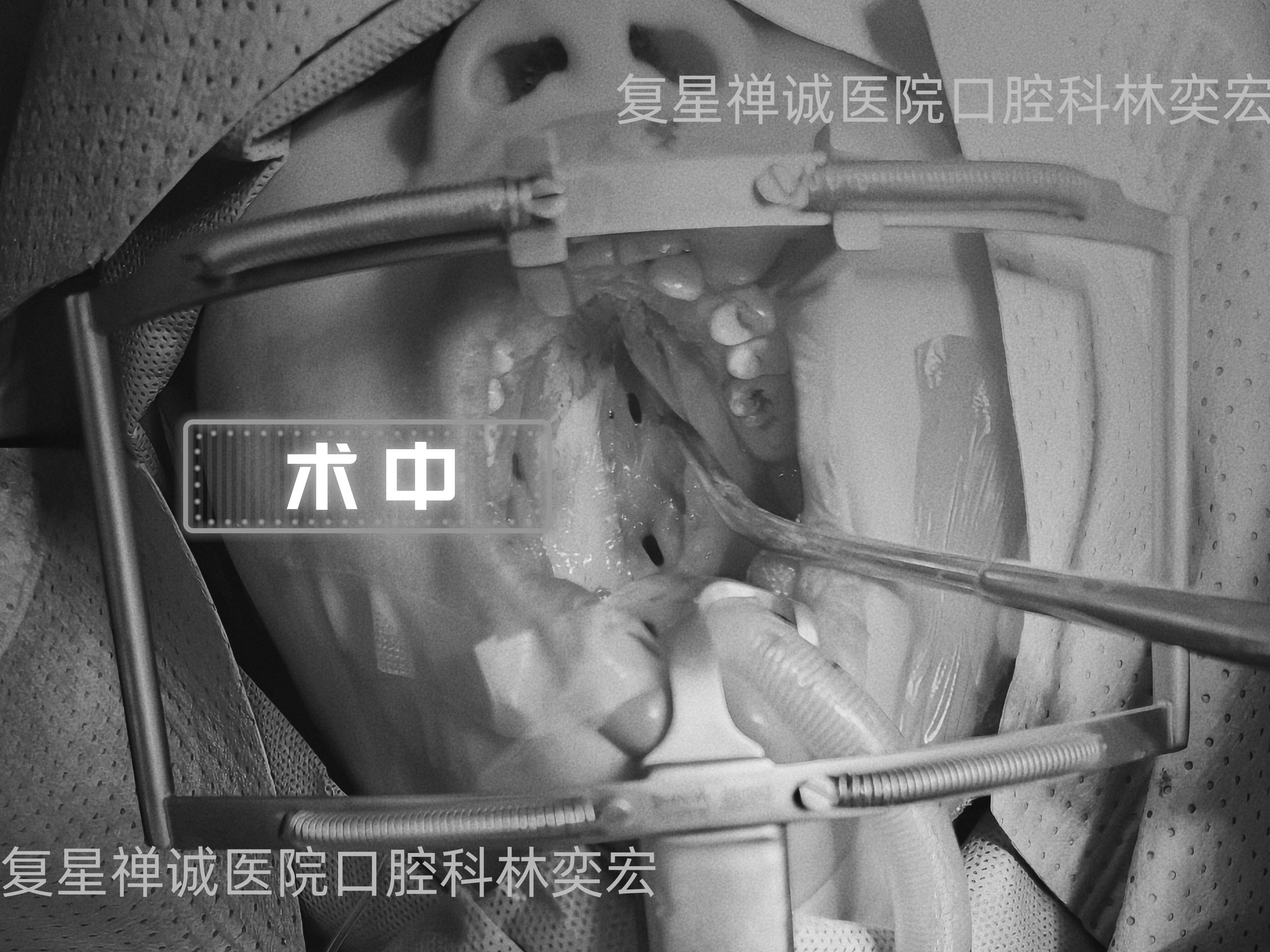 种植效果